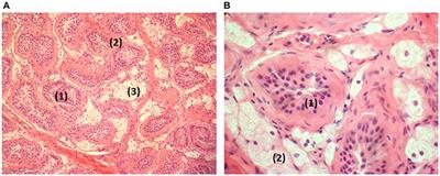 Thirty-eight-year follow-up of two sibling Lipoid Congenital Adrenal Hyperplasia patients  due to homozygous Steroidogenic Acute Regulatory (STARD1) protein Mutation. Molecular structure and modeling of the STARD1 L275P mutation.